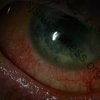 Right Eye - 24 year old male who suffered Toxic Epidermal Necrolysis Syndrome with severe Ocular involvement. Photo was taken 2 years after the initial TEN reaction